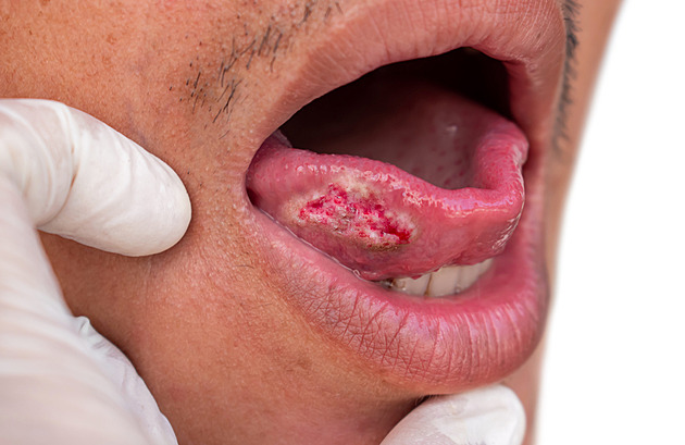 Rakovinu můžete mít i v ústech. Tyto příznaky nikdy nepřehlížejte